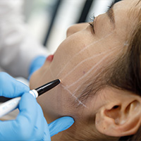 شدّ الوجه بالخيوط