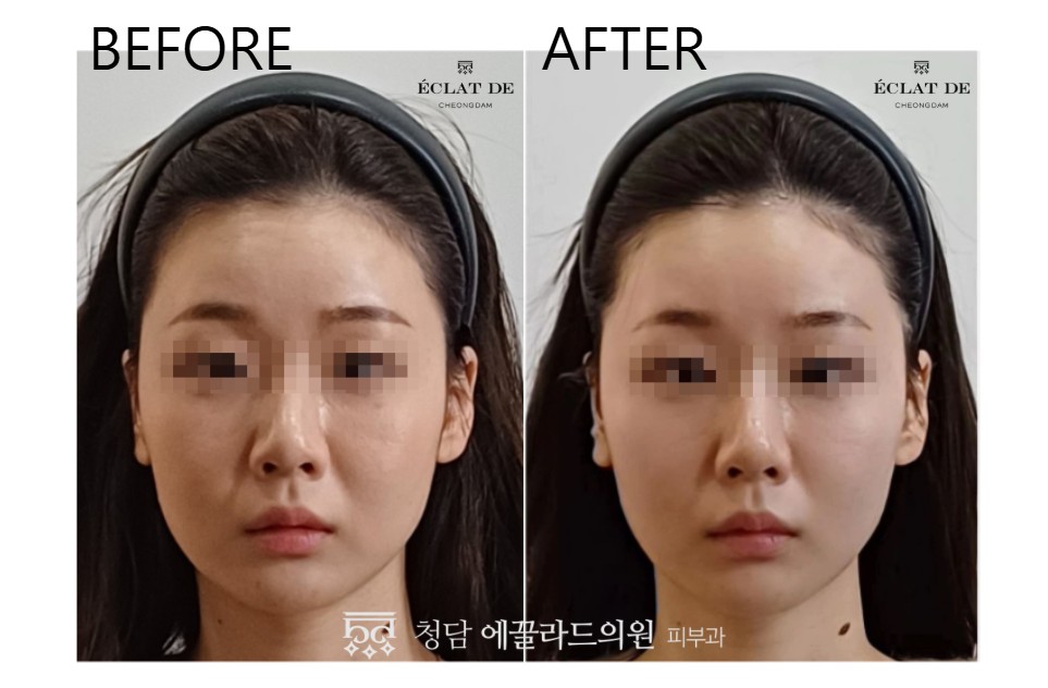  قبل وبعد  -  تجربة أوندا لشد الوجه  في إيكلات دي