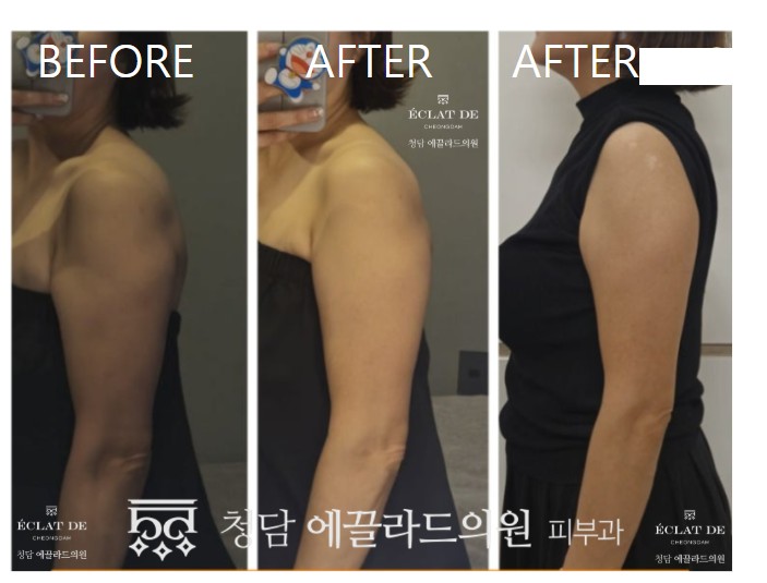 قبل وبعد - أوندا للجسم في  إيكلات دي