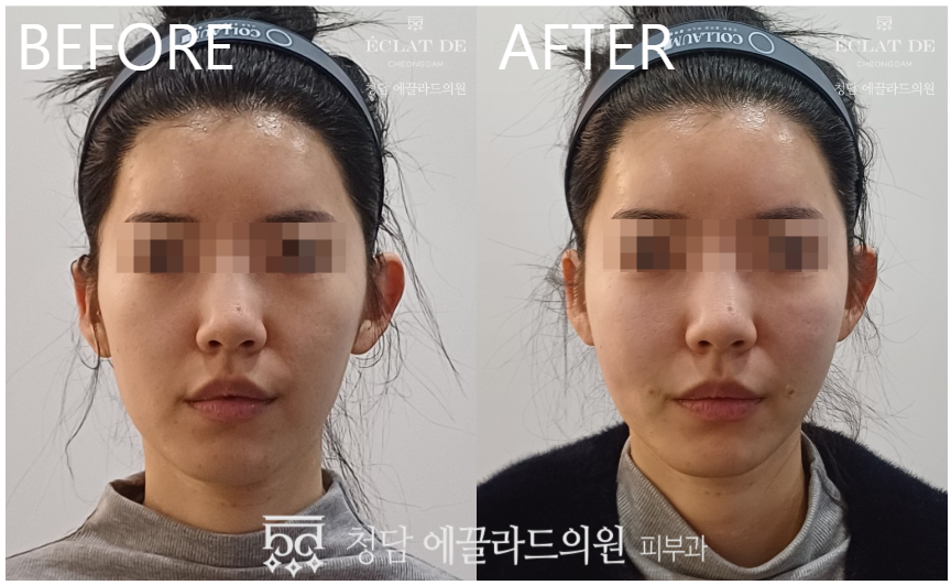 قبل وبعد-جوفلوك للبشرة في إيكلات دي