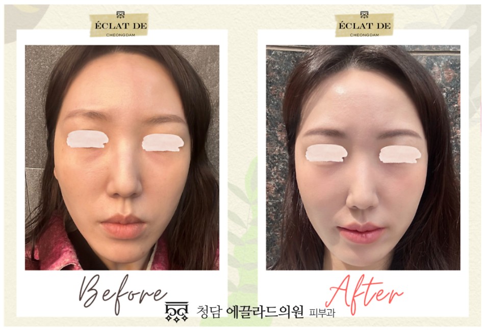 قبل وبعد-ألتراكول 200  في إيكلات دي  