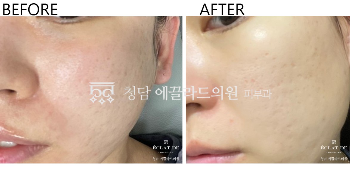 قبل وبعد - إليسيس سنس في إيكلات دي