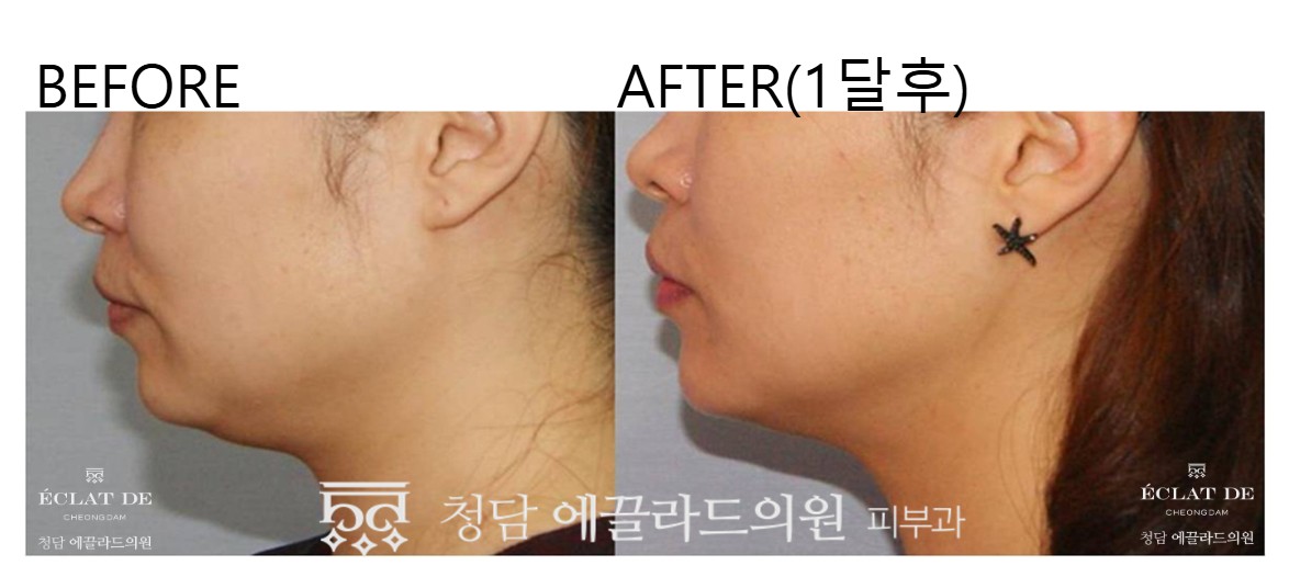 قبل وبعد-ألثيرابي برايم  في  إيكلات دي