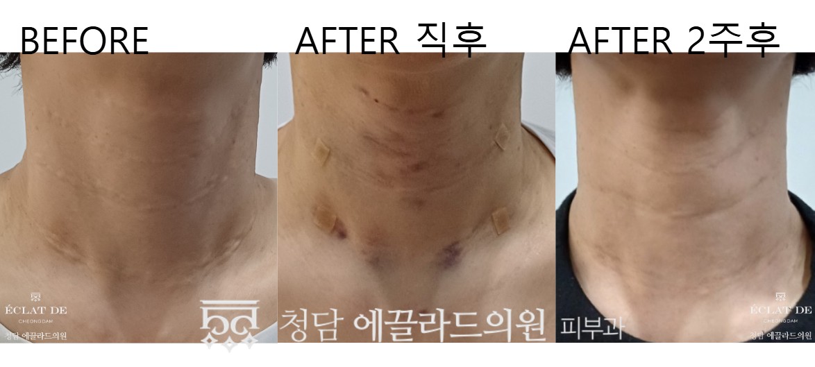 قبل وبعد-رادييس في إيكلات دي