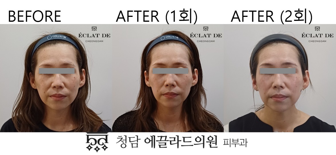 قبل وبعد-دوال تونينغ في إيكلات دي