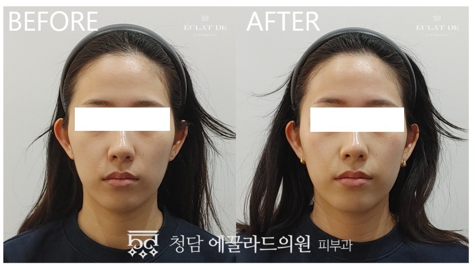 قبل وبعد-أوليجيو للرفع و الشد في إيكلات دي