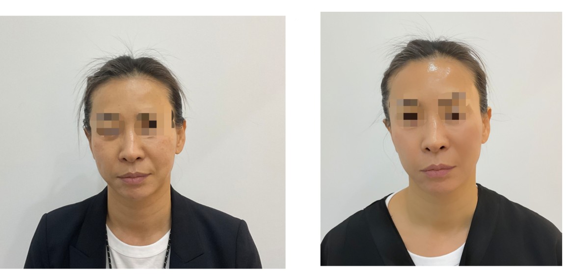 قبل وبعد- ثيرماج FLX في إيكلات دي