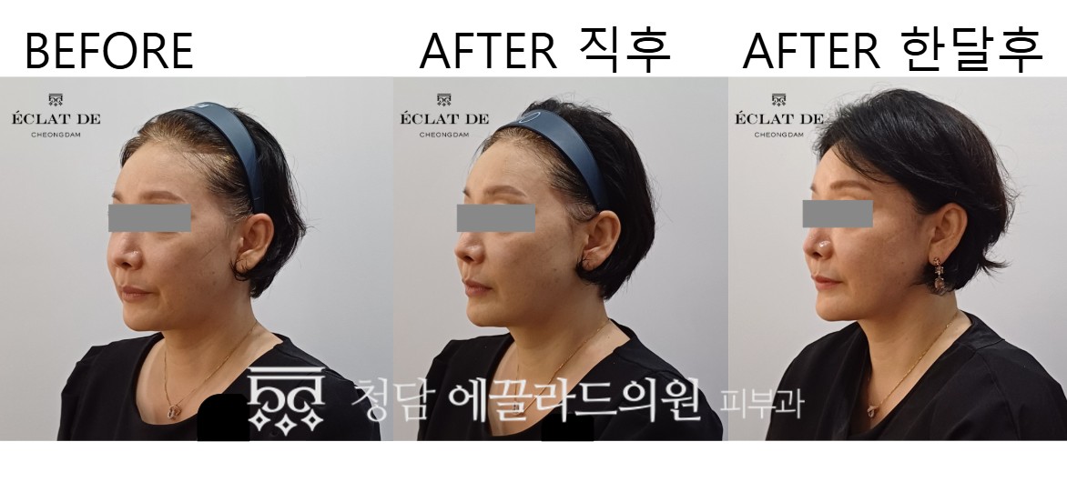 قبل وبعد- تيتانيوم ليفتينغ في إيكلات دي