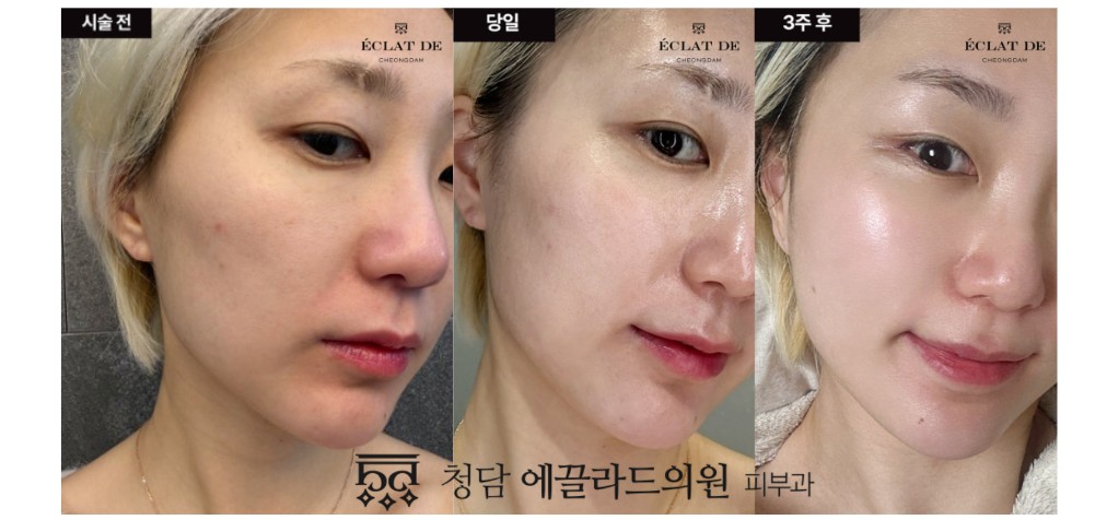 قبل وبعد-سكين أورا في إيكلات دي