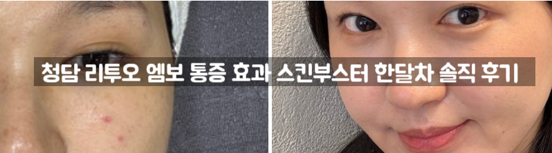 ريتو Re2o  – (تجربة صادقة) الألم، التعافي، النتائج أسبوع بأسبوع