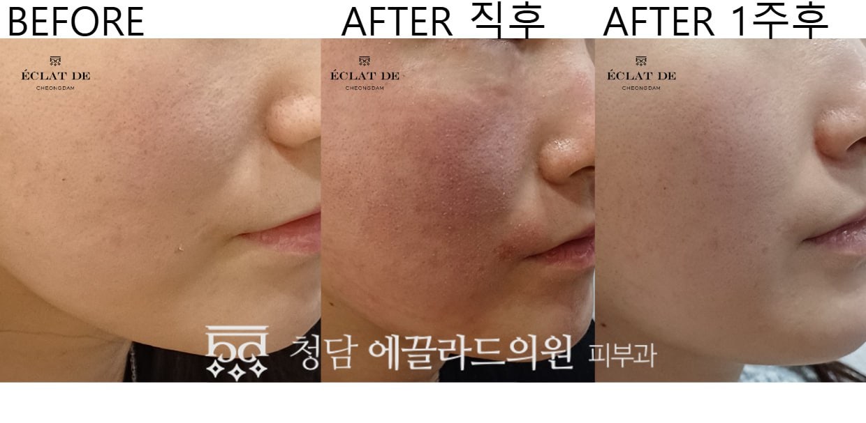 قبل وبعد- ريس نوفاي سكين بوستر في إيكلات دي