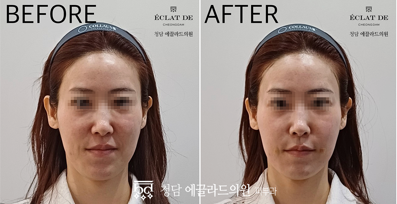 قبل وبعد- تجربة جوفلوك فوليوم لمنطقة خطوط الابتسامة في إيكلات دي