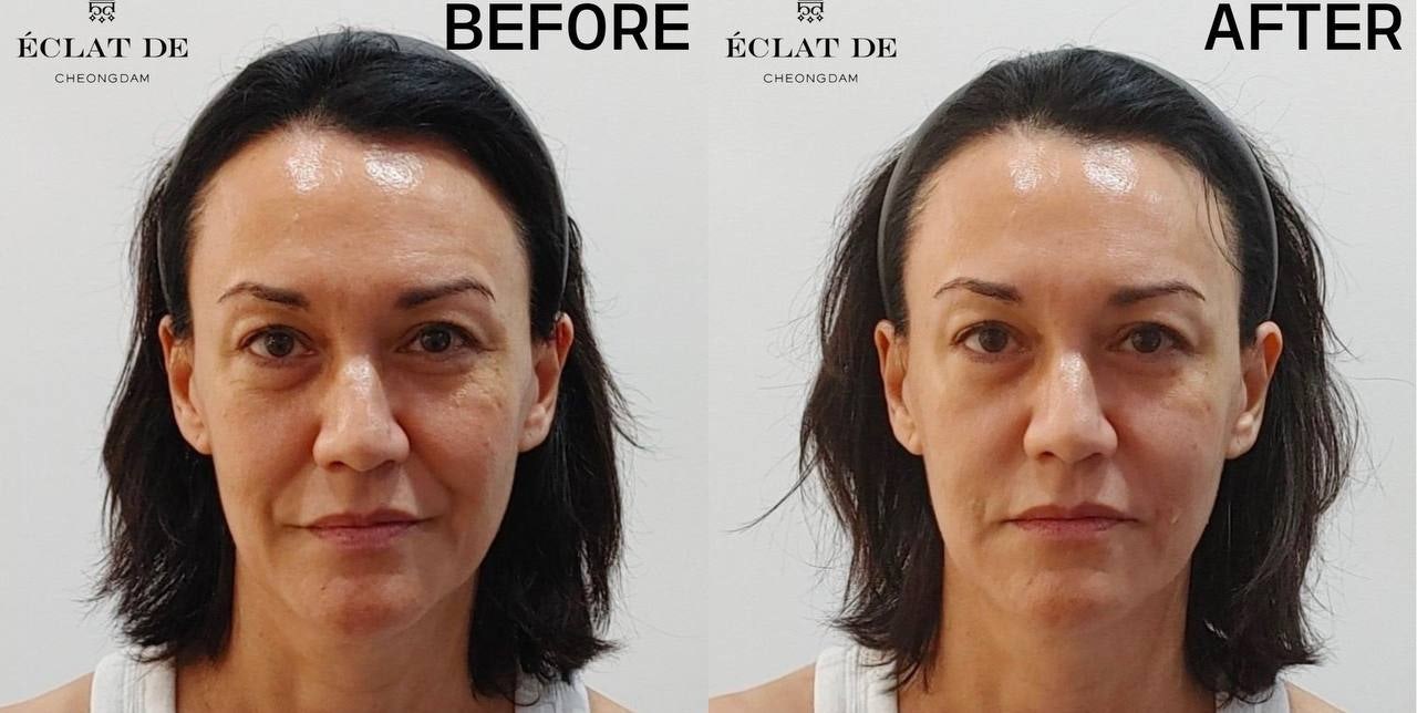 قبل وبعد-بيلوتيرو فيلر خطوط الابتسامة في إيكلات دي