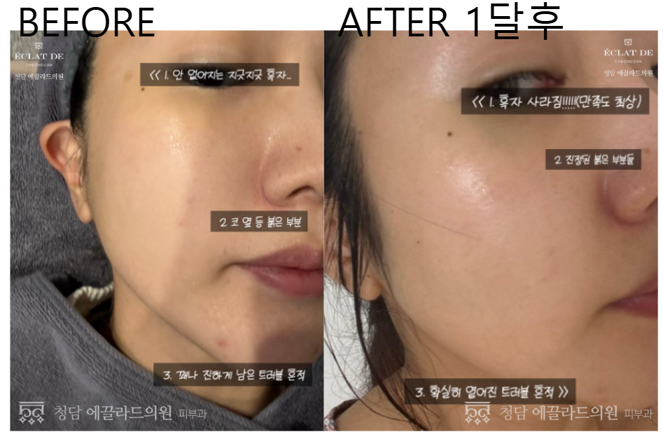 قبل وبعد- دوال تونينغ  في إيكلات دي